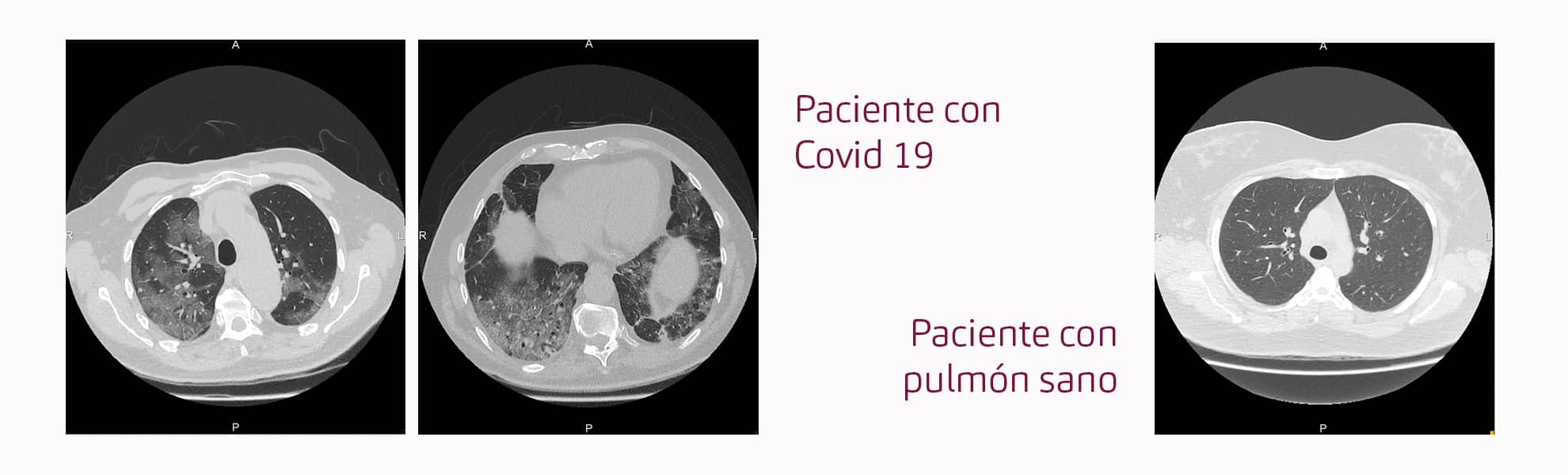 el-tac-pulmonar-se-empieza-a-utilizar-en-creu-blanca-para-detectar-la-afectacion-pulmonar-causada-por-el-covid-19-id-125