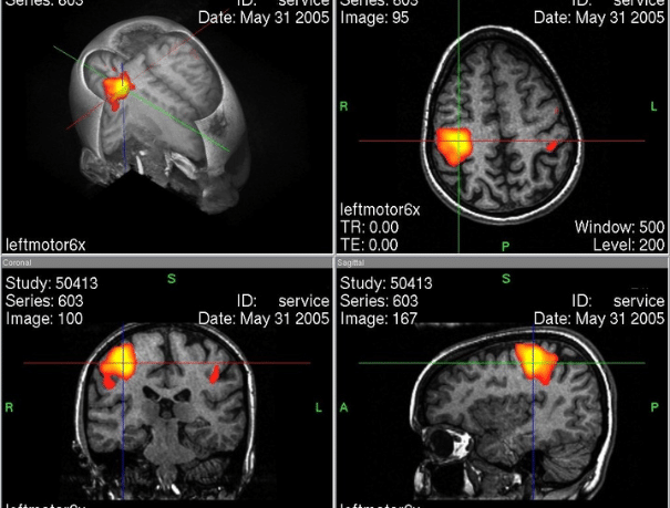 Resonancia Magnética Funcional (fMRI)